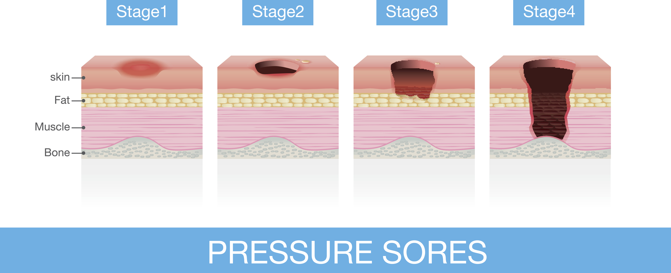 stages-of-pressure-ulcers-chart-bedsore-decubitus-poster